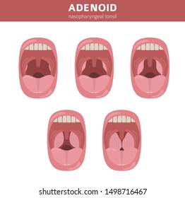 Nasal and throat, nasopharynx diseases. Adenoids diagnosis and treatment medical infographic design. Vector illustration