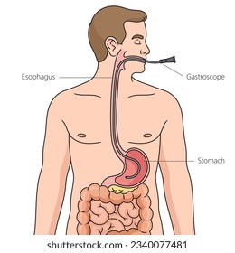 Nasogastric intubation diagram schematic vector illustration. Medical science educational illustration