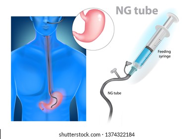 Nasogastric intubation  (nasogastric tube or NG tube) svg