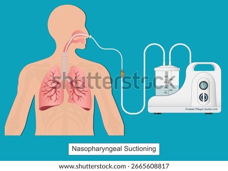 Nasogastric (NG) suctioning is the process of using a nasogastric tube inserted through the nose and into the stomach to remove fluids and air from the stomach.Medical health care vector illustration.