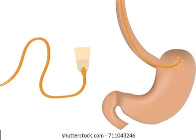 Nasogastric Tube