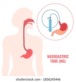 Nasogastric tube passed through the nose to stomach. NG with a syringe for feeding and administering medication. Health care and emergency medical concept. Vector illustration. svg