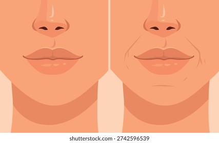 Nasolabial fold. Vector illustration, young and aged facial skin. The lip and nose area. Smooth, taut skin, wrinkles, sagging, loss of volume. For anti-aging products, skin care, cosmetic surgery