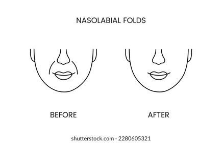 Nasolabial folds, laser cosmetology before procedure and after applying treatment line icon in vector. Illustration of a man with smooth clean skin and wrinkles