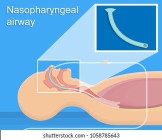 Nasopharyngeal airway device insertion NPA nasal trumpet nose hose clinic