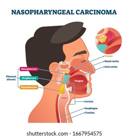 Nasopharyngeal carcinoma tumor, vector illustration labeled diagram. Medical nose, mouth and throat cross section scheme with problem area. Health care educational information. Nasal and oral cavity