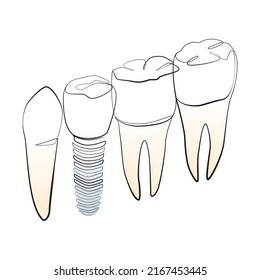 Natural and artificial teeth line art on white isolated background