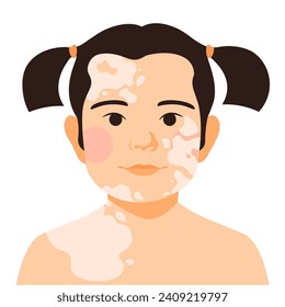 Natural beautiful child with skin spots, modern fashionable person with vitiligo. Flat vector illustration of a portrait of a young Asian girl with a skin feature. 