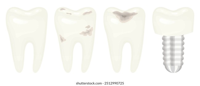 Naturalistic images of teeth in different conditions. White, healthy tooth with roots, teeth with caries and damage, dental implant. Molar, oral hygiene. Vector illustration for dentists.