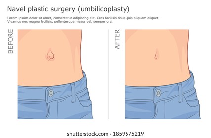 Navel plastic aesthetic surgery vector illustration. Before and after. Umbilicoplasty. 