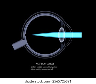 Nearsightedness eye disease anatomical poster. Myopia or short sightedness refractive error, problem of blurred vision. Anatomy of human eye infographic, lens and retina medical vector illustration