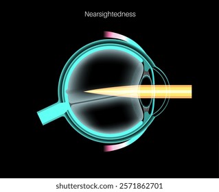 Nearsightedness eye disease anatomical poster. Myopia or short sightedness refractive error, problem of blurred vision. Anatomy of human eye infographic, lens and retina medical vector illustration