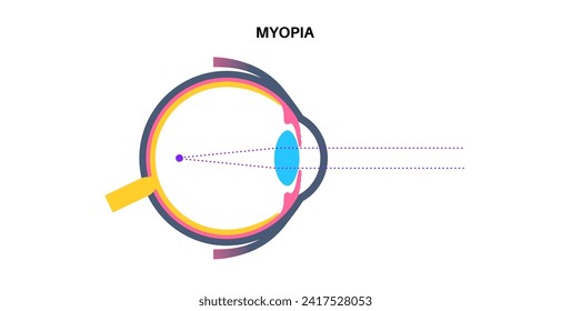 Nearsightedness eye disease poster. Myopia or short sightedness refractive error concept, problem of blurred vision. Anatomy of human eye infographic, lens and retina medical flat vector illustration