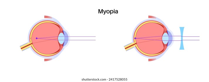 Nearsightedness eye disease poster. Myopia or short sightedness refractive error concept, problem of blurred vision. Anatomy of human eye infographic, lens and retina medical flat vector illustration