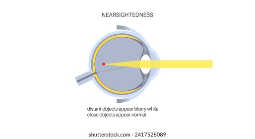 Nearsightedness eye disease poster. Myopia or short sightedness refractive error concept, problem of blurred vision. Anatomy of human eye infographic, lens and retina medical flat vector illustration