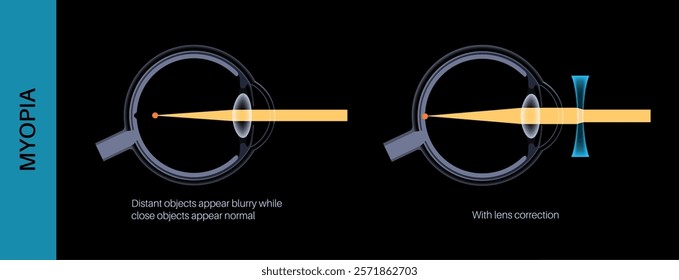 Nearsightedness eye disease. Vision correction with lens. Myopia or short sightedness refractive error, problem of blurred vision. Anatomy of human eye infographic, retina medical vector illustration