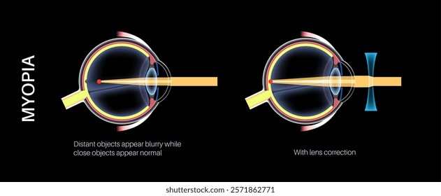 Nearsightedness eye disease. Vision correction with lens. Myopia or short sightedness refractive error, problem of blurred vision. Anatomy of human eye infographic, retina medical vector illustration