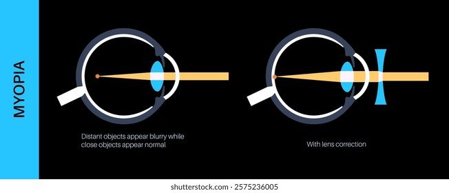 Nearsightedness eye disease. Vision correction with lens. Myopia or short sightedness refractive error, problem of blurred vision. Anatomy of human eye infographic, retina medical vector illustration