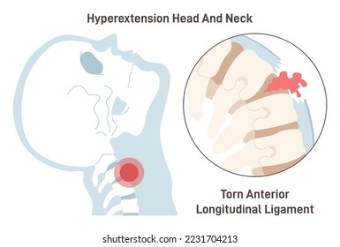 Neck hyperextension. Anterior longitudinal ligament torn. Spinal cord injury. Dangerous spine trauma. Flat vector illustration