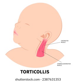 Neck muscle stiffness pain in adults or baby with chronic cervical dystonia disorder and the Torticollis of occupational therapy exercise svg