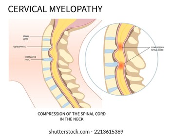 neck root injury with thoracic outlet pain damage spine canal syndrome or degeneration Herniation traumatic bone disk spurs painful of Spinal cord pinched nerves Tingling Numbness hand