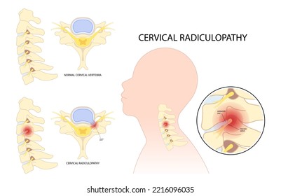 Neck Root Injury With Thoracic Outlet Pain Damage Spine Canal Syndrome Or Degeneration Herniation Traumatic Bone Disk Spurs Painful Of Spinal Cord Pinched Nerves Tingling Numbness Hand