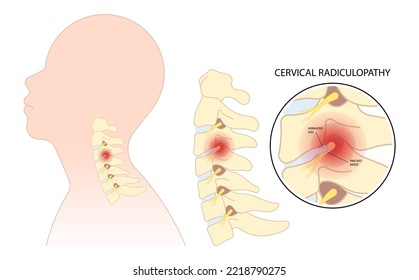 neck root injury with thoracic outlet pain damage spine canal syndrome or degeneration Herniation traumatic bone disk spurs painful of Spinal cord pinched nerves Tingling Numbness hand