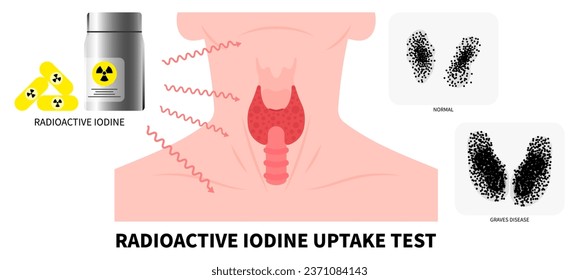 Hypothyreose und Schilddrüsenprüfung mit radioaktivem Jod - das Konzept der Medizin