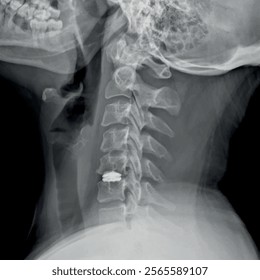 Neck X-ray of a patient undergoing Cervical Microdiscectomy and Cervical Disc Prosthesis for Medical Research and Teaching. Vector illustration.