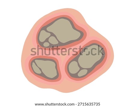 Necrosis Dead Tissue Clip Art