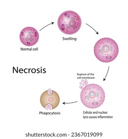 Necrosis, Muerte de Células Patológicas, Muerte de los tejidos corporales, Lesiones celulares que resultan en la muerte prematura de células en el tejido vivo por autólisis.