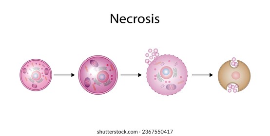 Necrosis, Muerte de Células Patológicas, Muerte de los tejidos corporales, Lesiones celulares que resultan en la muerte prematura de células en el tejido vivo por autólisis.