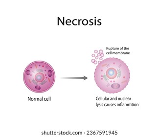 Necrosis, Muerte de Células Patológicas, Muerte de los tejidos corporales, Lesiones celulares que resultan en la muerte prematura de células en el tejido vivo por autólisis.