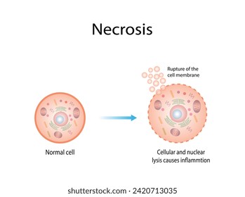 Necrosis, Muerte de Células Patológicas, Muerte de los tejidos corporales, Lesiones celulares que resultan en la muerte prematura de células en el tejido vivo por autólisis.