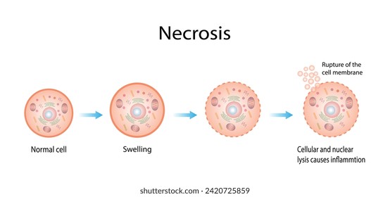 Necrosis, Muerte de Células Patológicas, Muerte de los tejidos corporales, Lesiones celulares que resultan en la muerte prematura de células en el tejido vivo por autólisis.