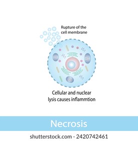 Necrosis, Muerte de Células Patológicas, Muerte de los tejidos corporales, Lesiones celulares que resultan en la muerte prematura de células en el tejido vivo por autólisis. Ilustración vectorial.