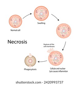 Necrosis, Muerte de Células Patológicas, Muerte de los tejidos corporales, Lesiones celulares que resultan en la muerte prematura de células en el tejido vivo por autólisis. Ilustración vectorial.