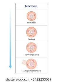 Necrosis, Muerte de Células Patológicas, Muerte de los tejidos corporales, Lesiones celulares que resultan en la muerte prematura de células en el tejido vivo por autólisis. Ilustración vectorial.