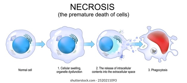 Necrosis. Premature Uncontrolled cell death. Cell membrane rupture and Cell fragmentation. Phagocytosis. Vector. Schematic diagram. Detailed poster.