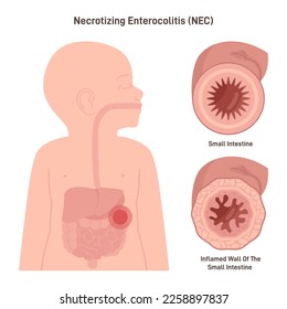 Necrotizing enterocolitis or NEC. Serious gastrointestinal patology that mostly affects premature babies, intestinal tissue inflamation. Flat vector illustration