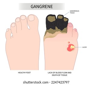 Necrotizing fasciitis artery syndrome diabetic foot skin toe acute sore pain amputation cell bacteria traumatic fungus and sunburn of Raynaud's vascular limb ischemic leg cold pus dry wet gas