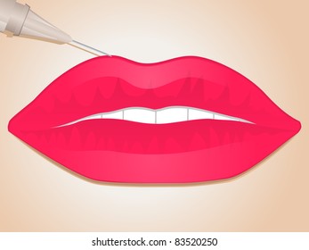 needle about to inject lip filler into pink lips