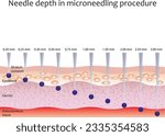 Needle depth in micro needling treatment. Skin layers and needles injection.