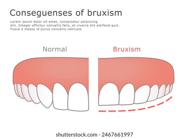 
Consecuencias negativas del bruxismo en la ilustración dental. Dientes sanos y síntomas de bruxismo Ilustración vectorial. 