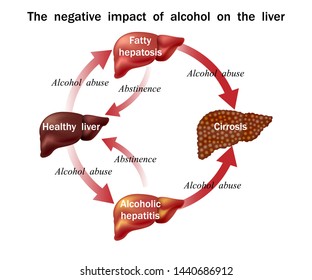 the negative effect of alcohol on the liver , the round diagram shows the reversible and irreversible effect of alcohol on the liver