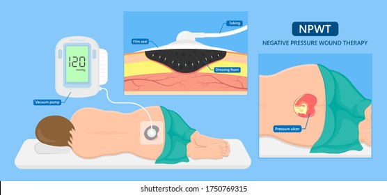 Negative Pressure Wound Therapy NPWT Leg Bed VAC Deep Vein Care Foot Skin Burn Heal Pump