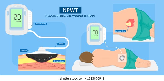 Negative pressure wound therapy NPWT leg bed VAC deep vein care Foot skin burn heal pump