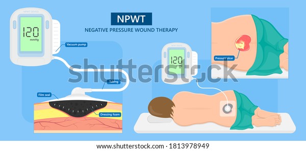 negative pressure wound therapy ncbi