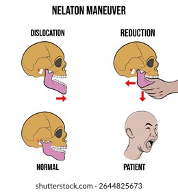 Nelaton maneuver, conventional reduction technique in patient.