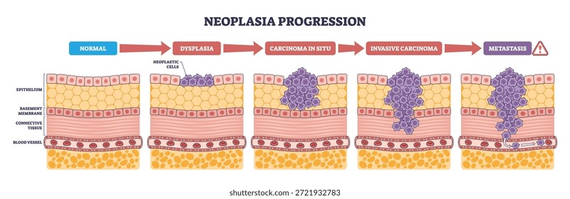 La progresión de la neoplasia visualiza el cambio del epitelio normal a la displasia, el carcinoma in situ, la invasión y la metástasis, los Elementos clave, el epitelio, las células neoplásicas, las flechas. Diagrama